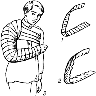 Рис. 2.3. Использование проволочной лестничной шины Крамера при переломе плечевой кости:<br>1 – общий вид шины; 2 – шина, проложенная ватой и марлей; 3 – наложенная шина