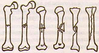 Рис. 2.1. Виды переломов трубчатых костей в зависимости от формы и направления перелома